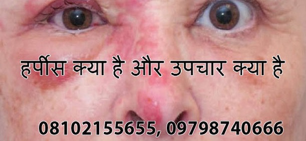 Medicines and Treatment for Herpes Simplex