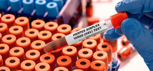 हर्पीस सिम्प्लेक्स का इलाज