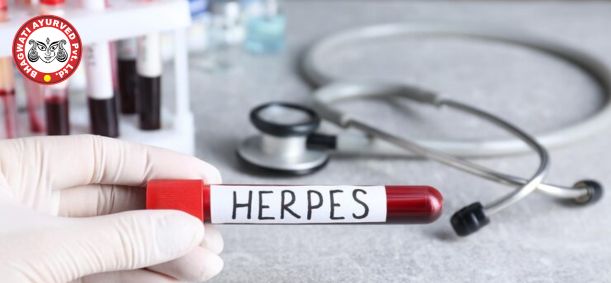 Herpes Simplex Treatment in Telangana